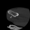 SPORK, NICO - 22.03.1976 - 02.08.2022 - CT obere Extremität - 17:51:17
